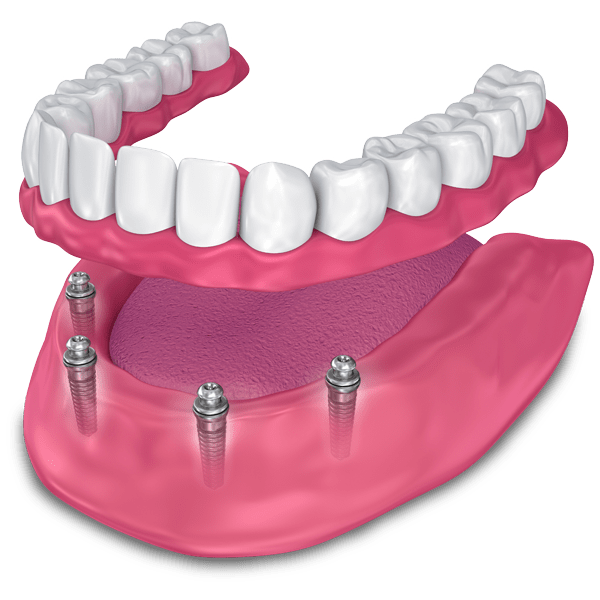 implant supported dentures model Falls Church, VA