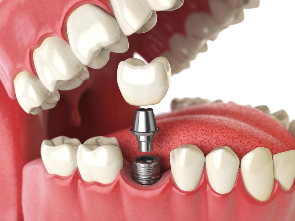 Dental Implant Cost Breakdown