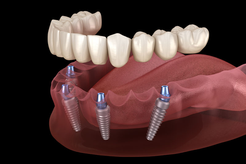 an All-On-Four® dental implant model showing four dental implant posts and a dental prosthesis hovering over the dental implants.
