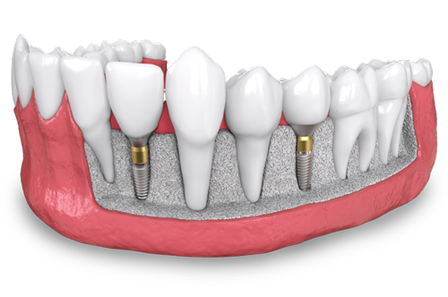 a model of placed dental implants