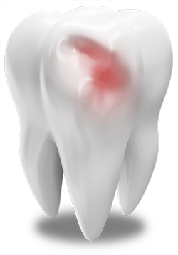 a model of a damaged tooth