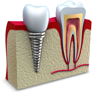 a model of a placed dental implant