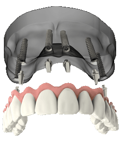a model of full arch dental implants