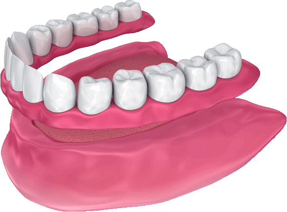 a model of traditional dentures