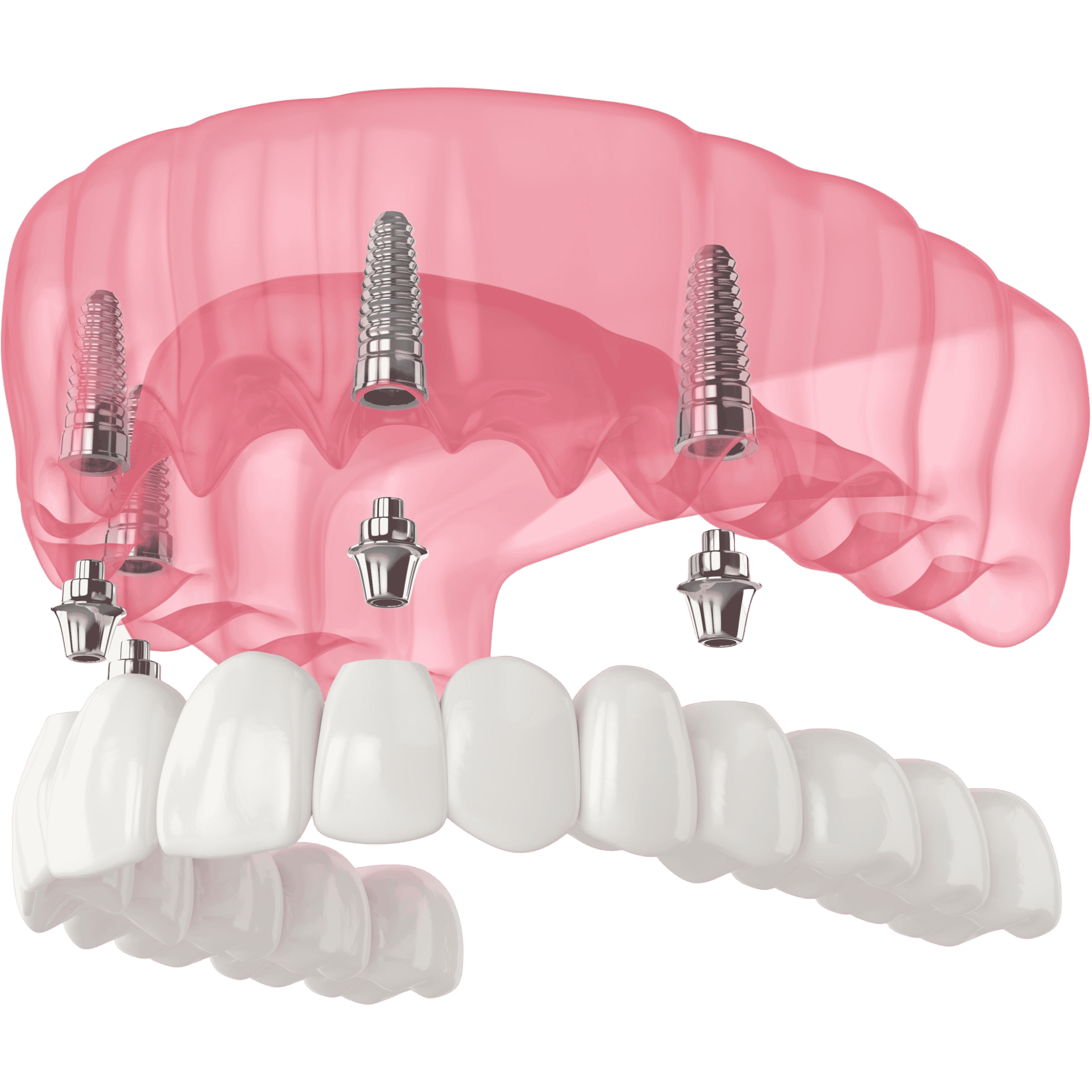 Restore an entire arch of missing teeth with our full-arch dental implants. This treatment is ideal for patients who are missing all of their teeth on the top or bottom arch. In one surgery, we can place a full arch of implants, so you enjoy life-changing results in one day.