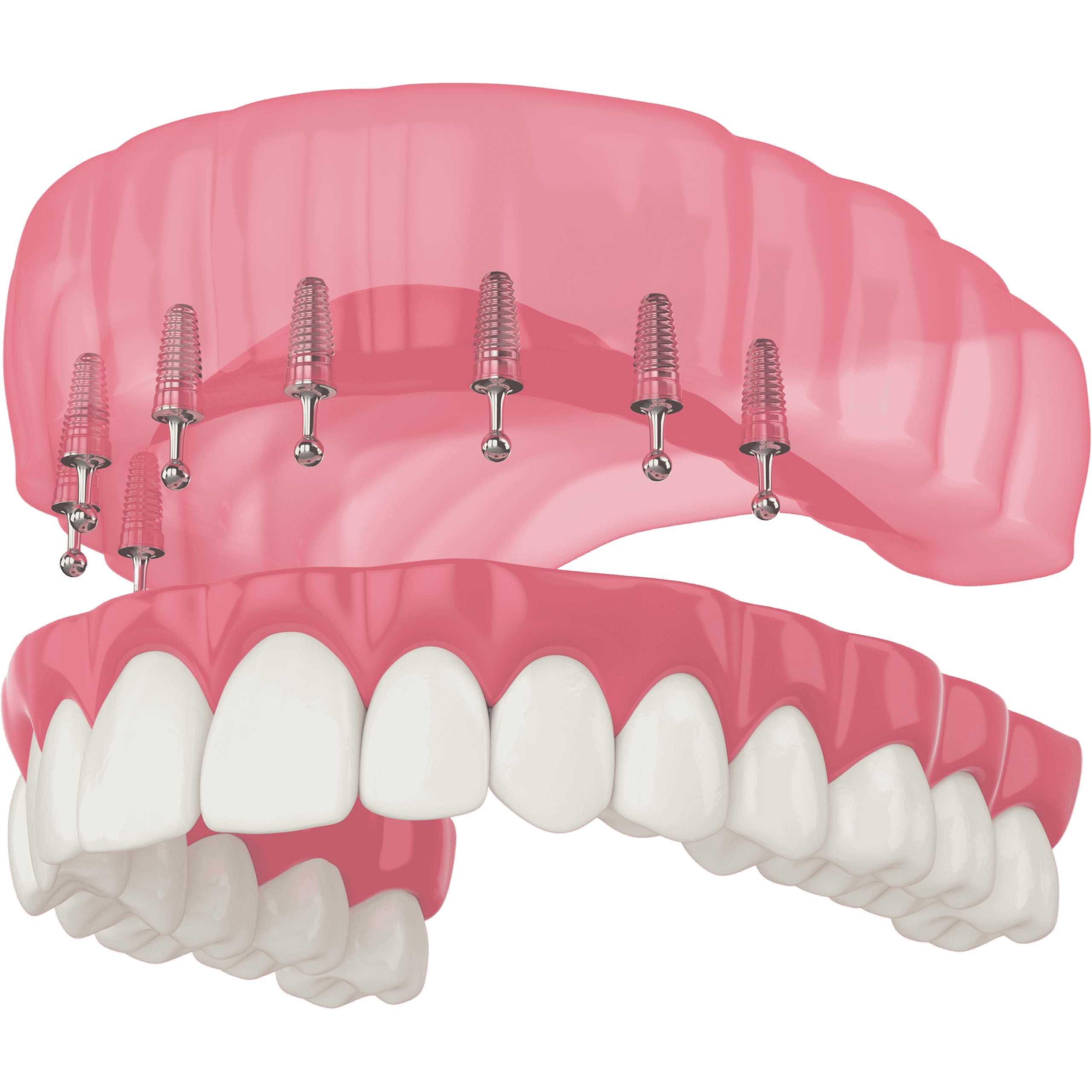 If you are missing a full arch of teeth, you may be a candidate for our implant-supported dentures. This treatment combines the stability of dental implants with the convenience of dentures, so you can enjoy a beautiful and functional smile.