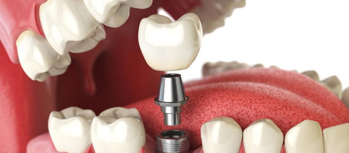 Dental Implant Cost Breakdown