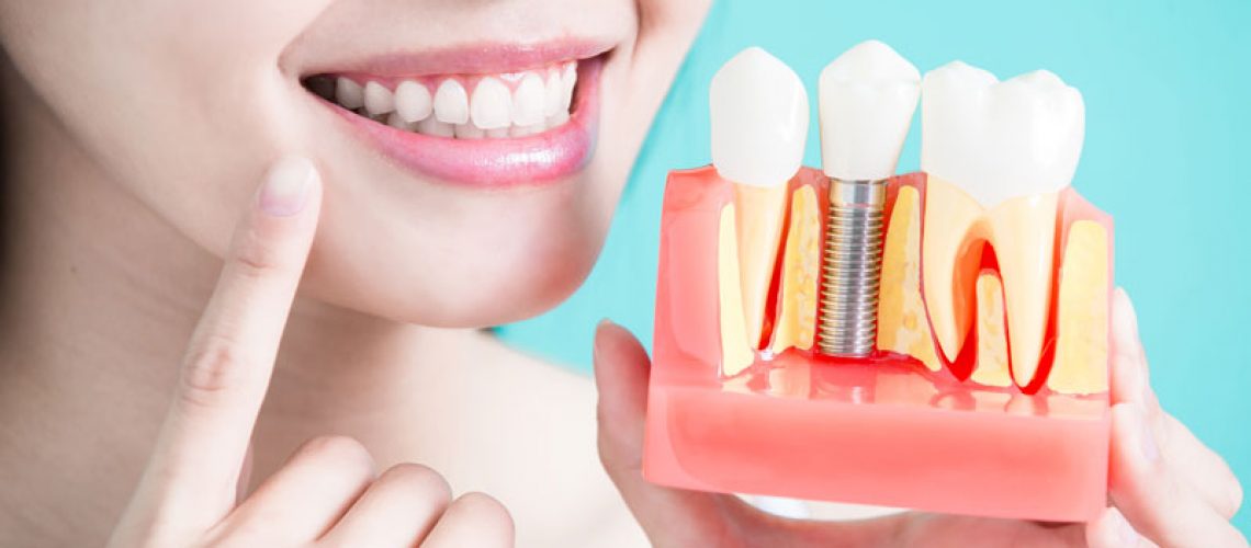 Patient Holding Up A Model Of A Dental Implant In Your Jaw