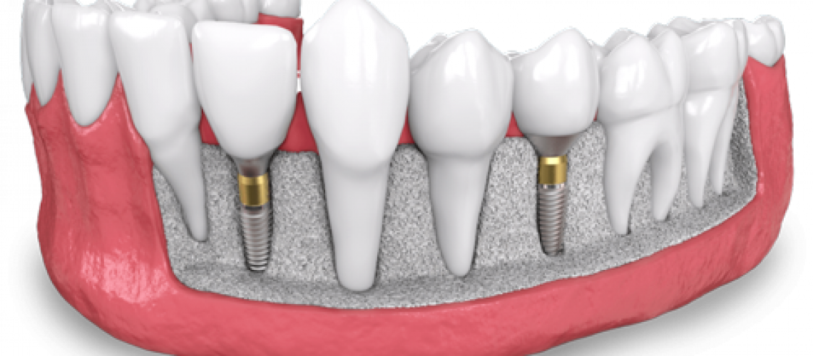 a model of two placed dental implants