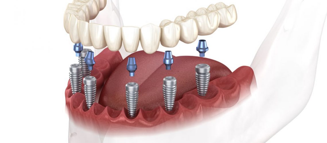 an image of a full mouth dental implant model for the lower arch. image shows the implant post which is under the abutment which is under the full mouth dental prosthetic.