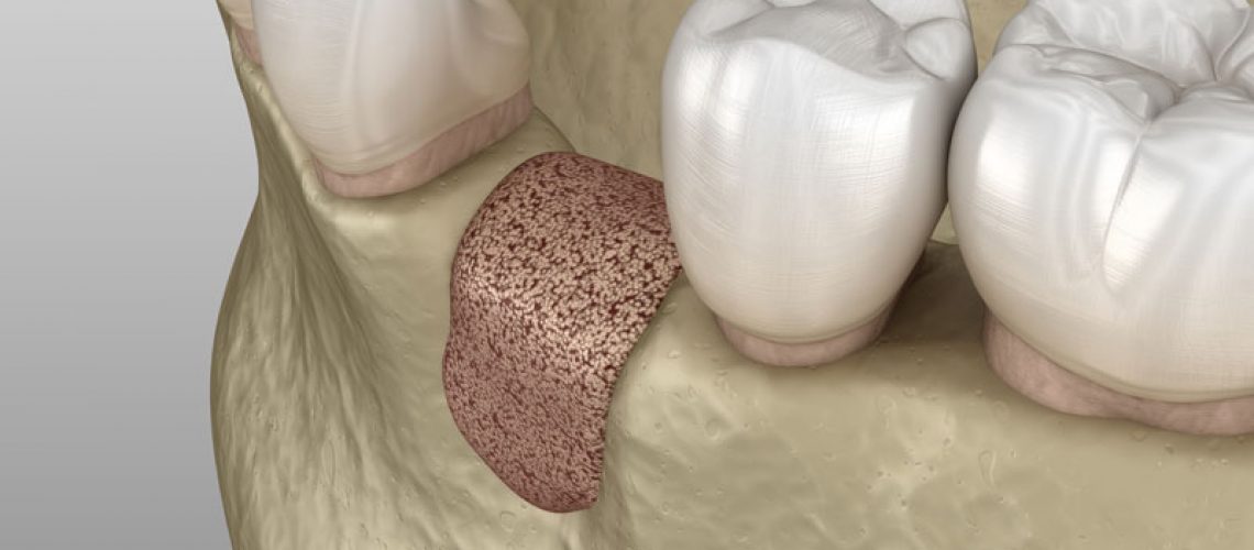 Bone Graft Where A Tooth is Missing In The Jaw