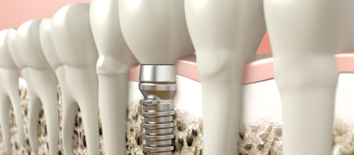 Dental Implant In Jawbone, Surrounded By Natural Teeth