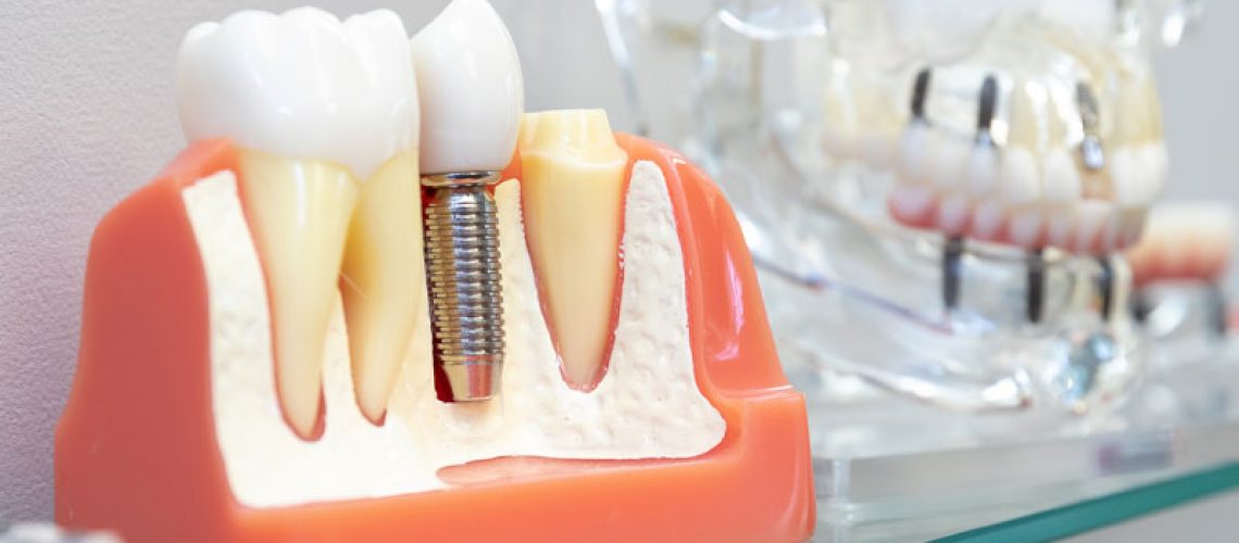 Dental Implant In Your Bone, Model
