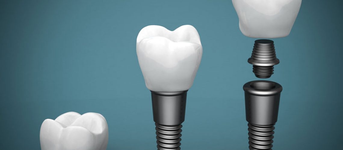 Dental Implant Models Together On A Blue Background