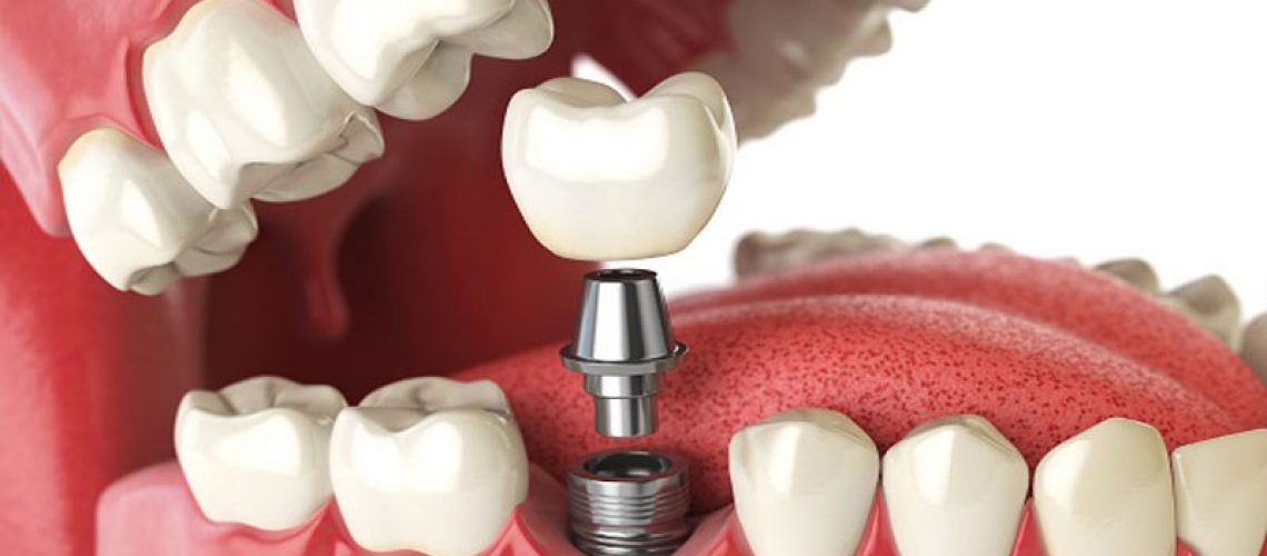 a single dental implant being put onto a post in a jawline model.
