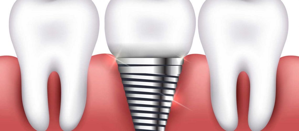 failing dental implants