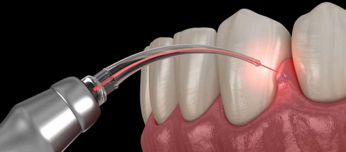 Gum Disease Laser Treatment Model